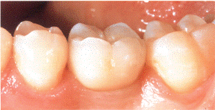 φωτογραφια οδοντικου εμφυτευματος